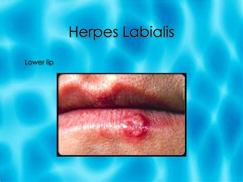 hermes labial|herpes labialis other names.